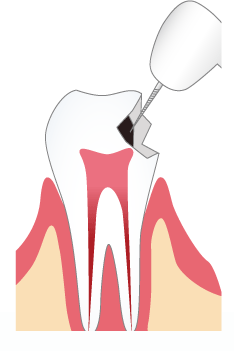 悪いところを削っている最中に歯の神経に触れてしまうかもしれません。
