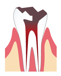 虫歯が神経に達してしまい、ズキズキと痛む場合