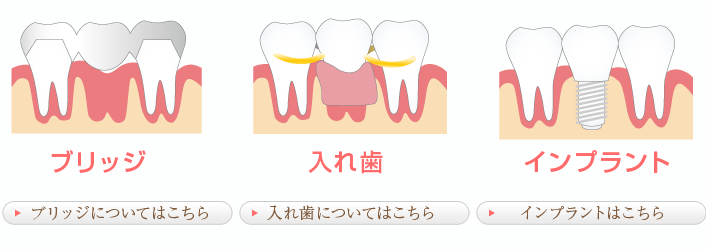 ①ブリッジ　　②義歯（入れ歯）　　③インプラント