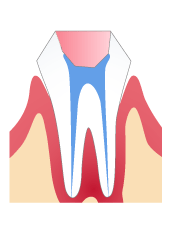 根管治療　Step 4