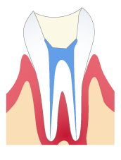 根管治療　Step 2