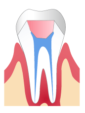 根管治療　Step 5