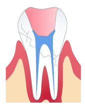 神経を取った歯