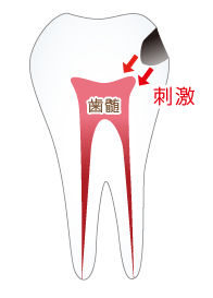 虫歯の可能性が大