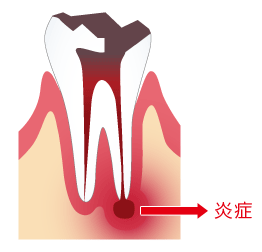 虫歯の放置により神経が腐っている状態