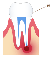 歯の根の治療の際に細菌が入ってしまっている状態