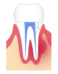 冠（差し歯・クラウン）を被せた歯の根がひび割れを起こしている状態