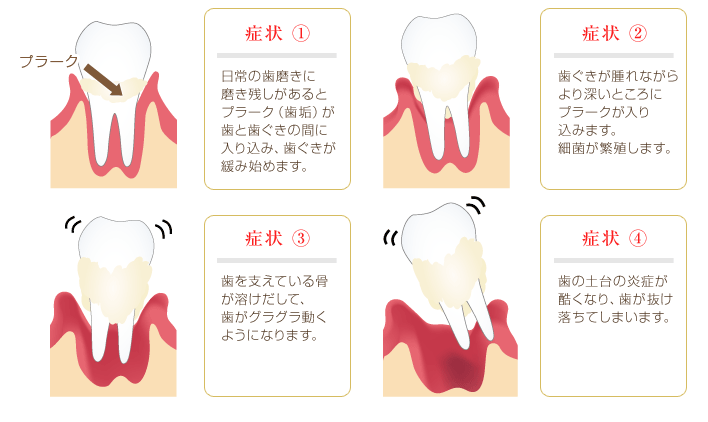 歯周病の症状