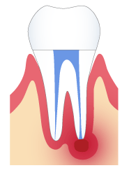 歯の根の治療の際に細菌が入ってしまっている状態