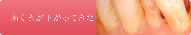 歯ぐきが下がってきた